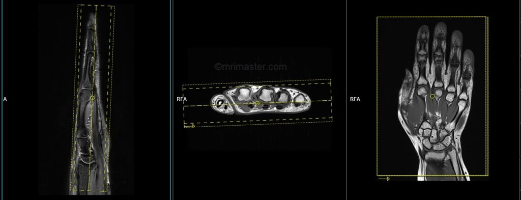 MRA hand dynamic protocol and planning of coronal scans