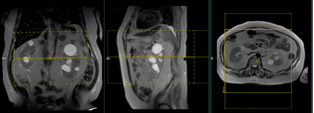 MRA non contrast renal artery scan axial image planning