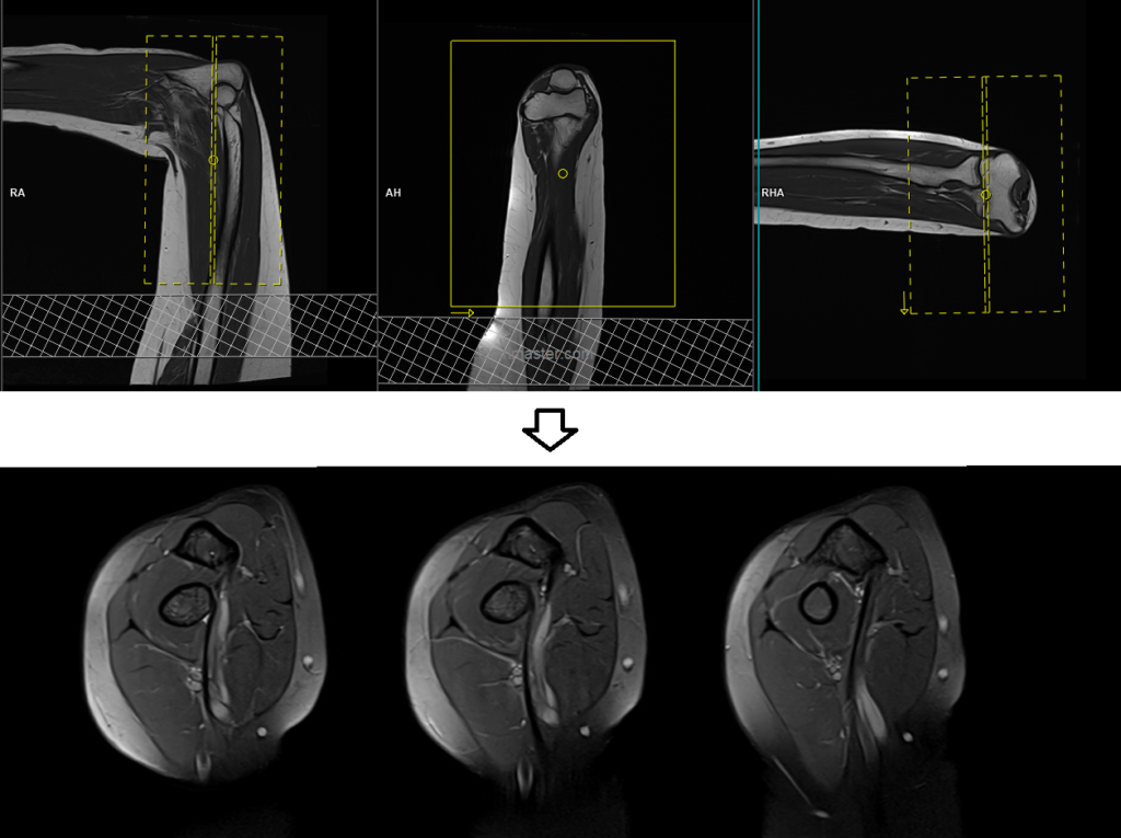 MRI FABS view coronal planning image