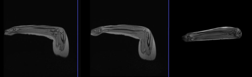 MRI FABS view localiser image