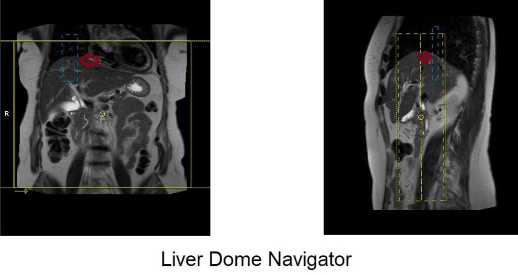 MRI Liver Dome Navigator