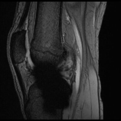 MRI Magnetic susceptibility artifact GRE knee scan MRI Magnetic susceptibility artifact GRE knee scan