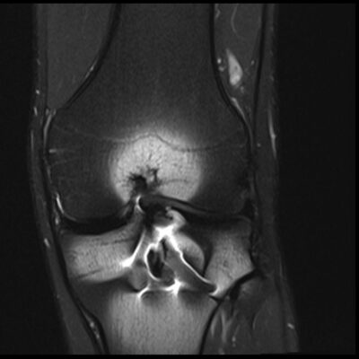 MRI Magnetic susceptibility artifact knee PD FS image MRI Magnetic susceptibility artifact knee PD FS image