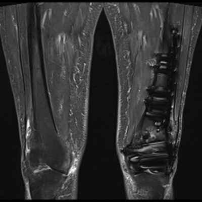 MRI Magnetic susceptibility artifact thigh STIR MRI Magnetic susceptibility artifact thigh STIR