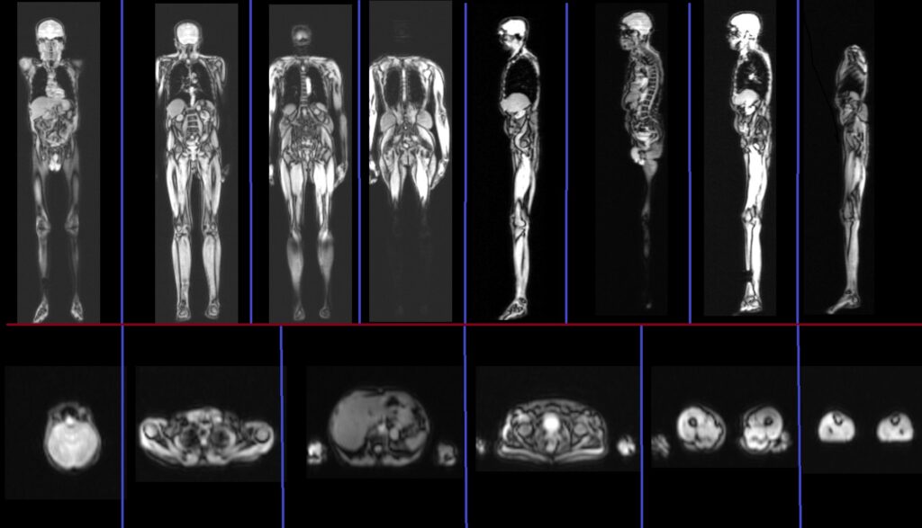 MRI Whole Body Magnetic Resonance Imaging (WB-MRI) with Diffusion-Weighted Imaging (DWI) localizer image