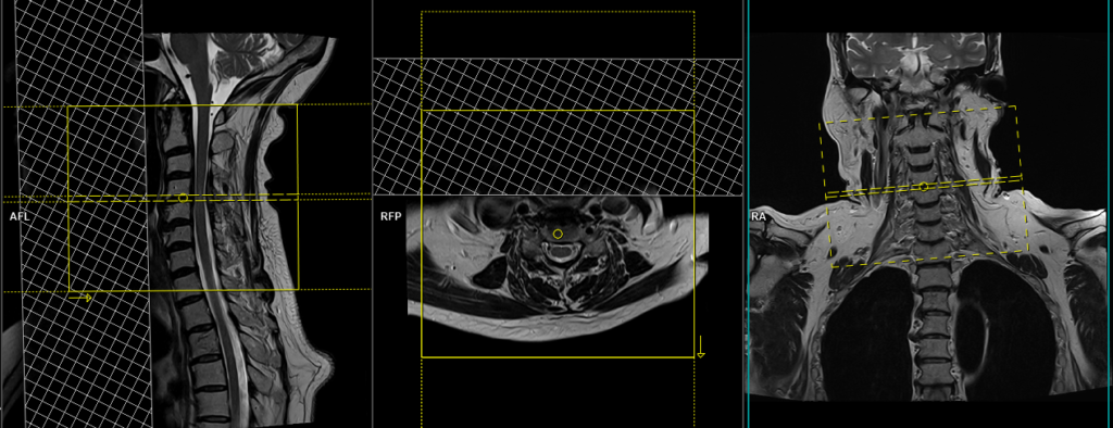 MRI cervical spine axial image planning