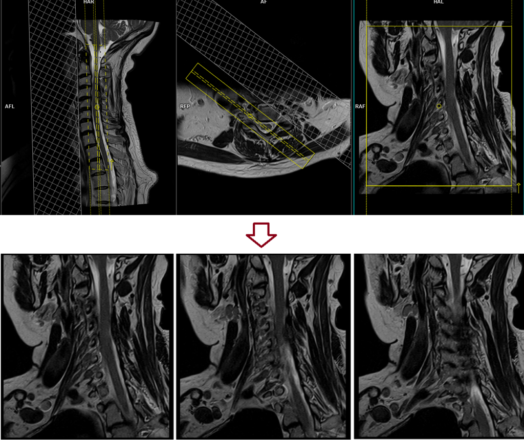 MRI cervical spine exit foramen view coronal oblique image planning RT