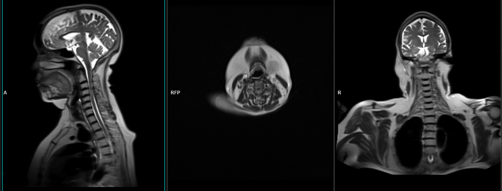 MRI cervical spine localiser image