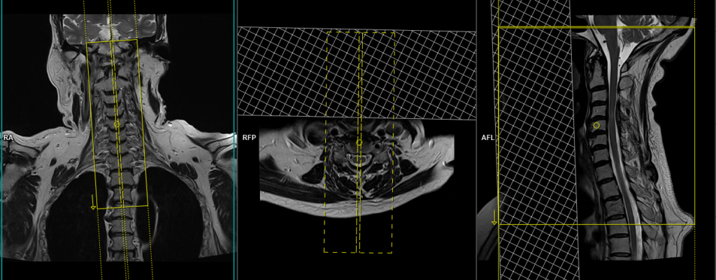 MRI cervical spine sagittal image planning