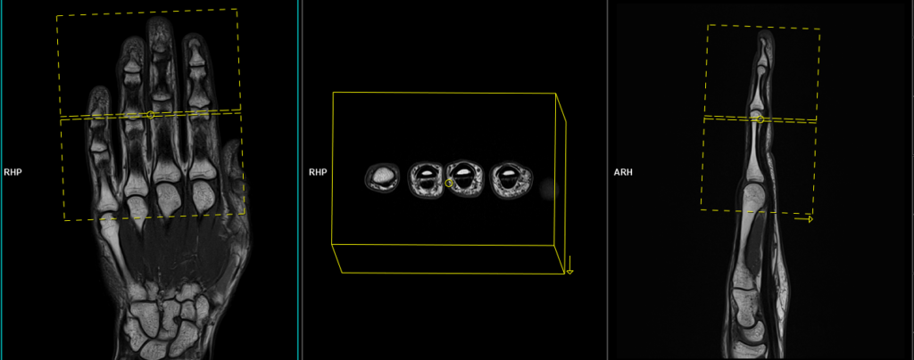 MRI fingers axial scan planning image
