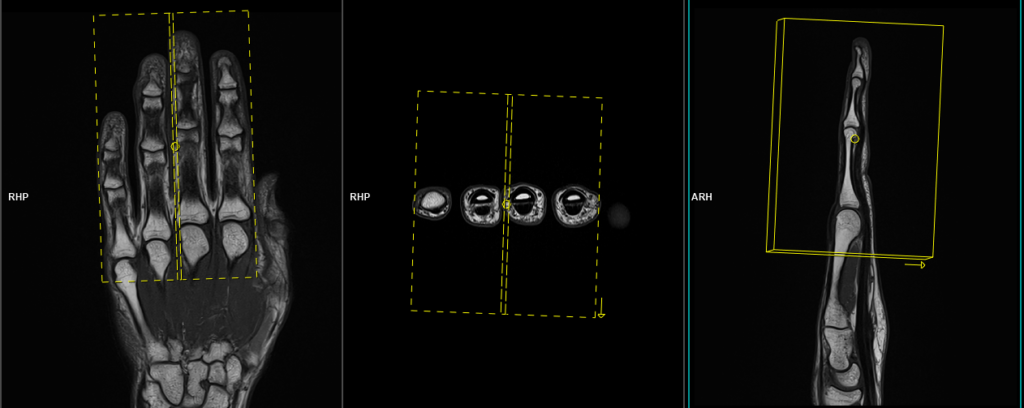MRI fingers sagittal scan planning image