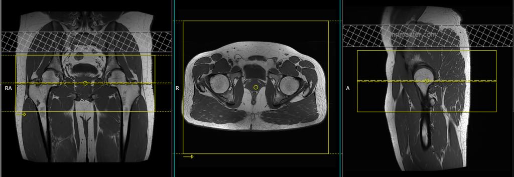 MRI hip arthrogram axial image planning and protocol