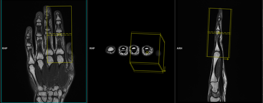 MRI index finger axial scan planning image