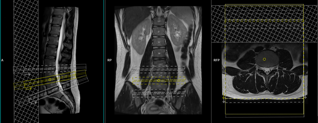 MRI lumbar spine axial scan planning and protocol image