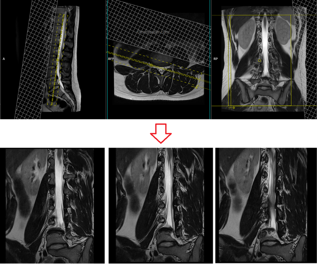MRI lumbar spine exit foramen view coronal oblique image planning