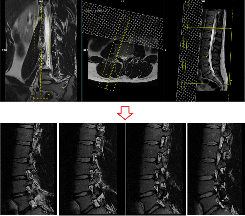 MRI lumbar spine exit foramen view sagittal oblique image planning