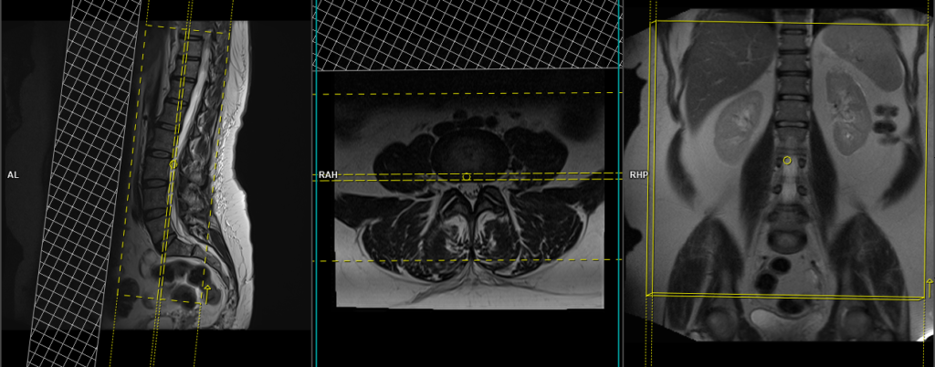 MRI lumbar spine protocol and planning of coronal scans
