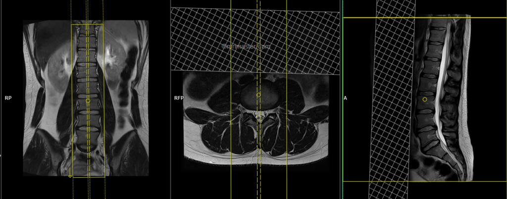 MRI lumbar spine sagittal scan planning and protocol image