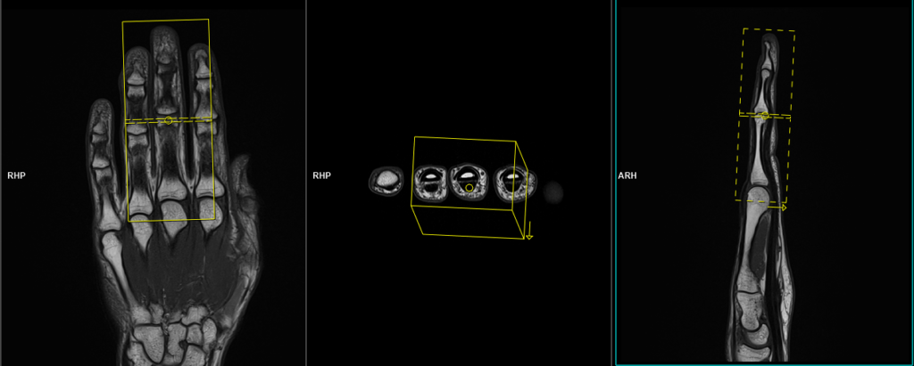MRI middle finger protocol and planning of axial SFOV scans