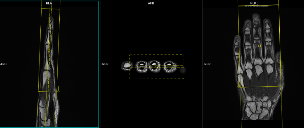 MRI middle finger protocol and planning of coronal SFOV scans