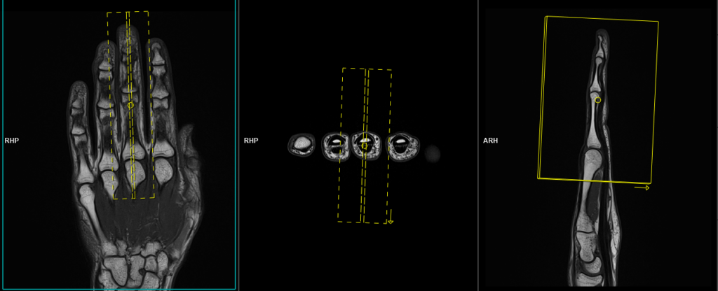 MRI middle finger protocol and planning of sagittal SFOV scans