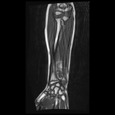 MRI motion artifact forearm MRI motion artifact forearm