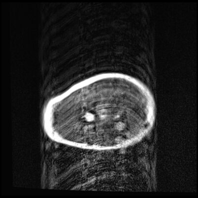 MRI motion artifact forearm axial MRI motion artifact forearm axial