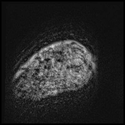 MRI motion artifacts in foot MRI motion artifacts in foot