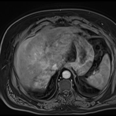 MRI motion artifacts in liver MRI motion artifacts in liver