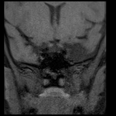 MRI pituitary motion artifact MRI pituitary motion artifact