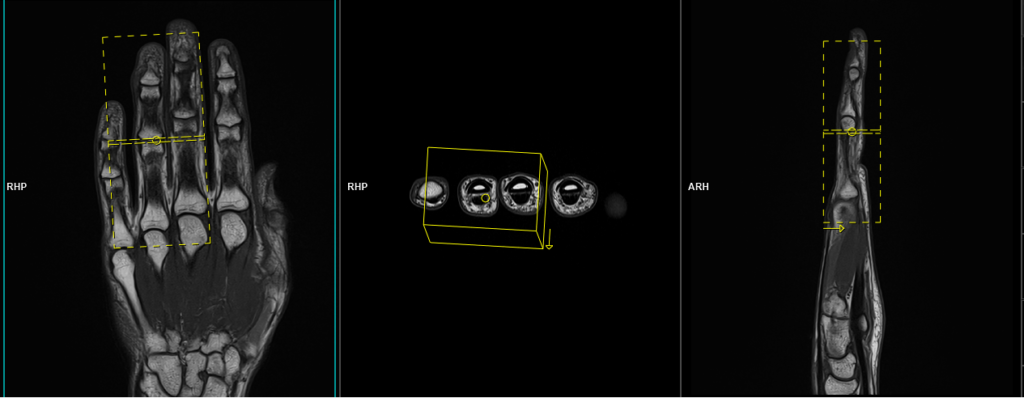 MRI ring finger axial scan planning image