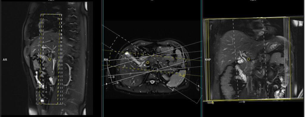 MRI secretin stimulated MRCP coronal haste thick slab planning