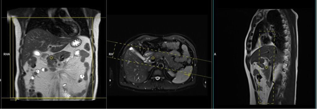 MRI secretin stimulated MRCP coronal thick slab planning