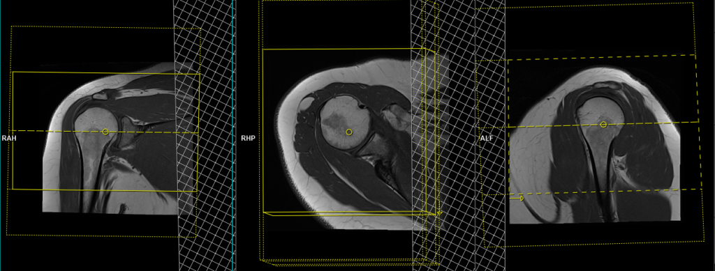 MRI shoulder arthrogram planning of axial 3D scans