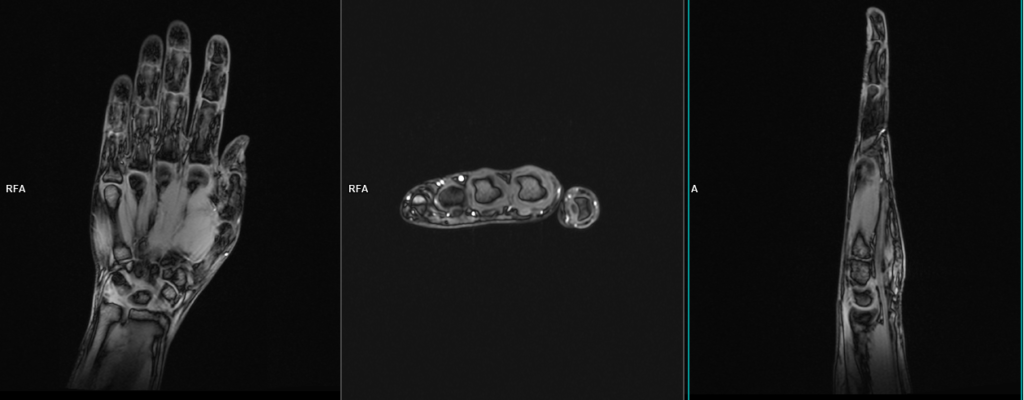 MRI thumb localiser image