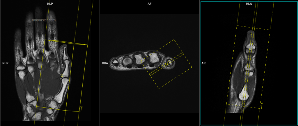 MRI thumb sagittal scan small FOV planning