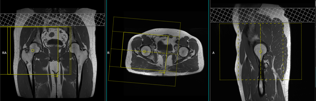 MRI unilateral hip arthrogram planning of coronal 3d scans