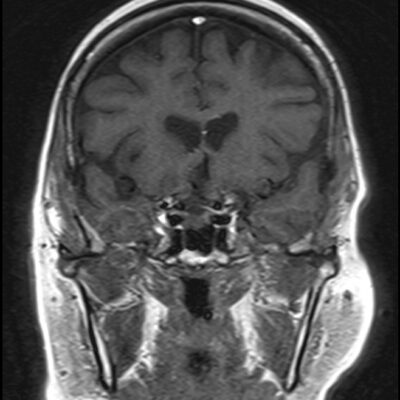 MRI zero filling artifact image MRI zero filling artifact image