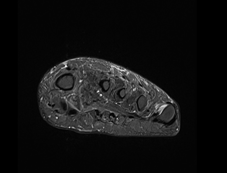 STIR axial image of foot