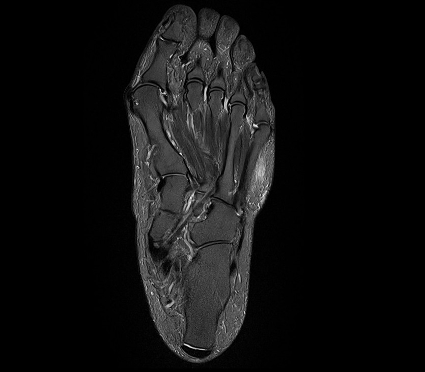 STIR coronal image of foot