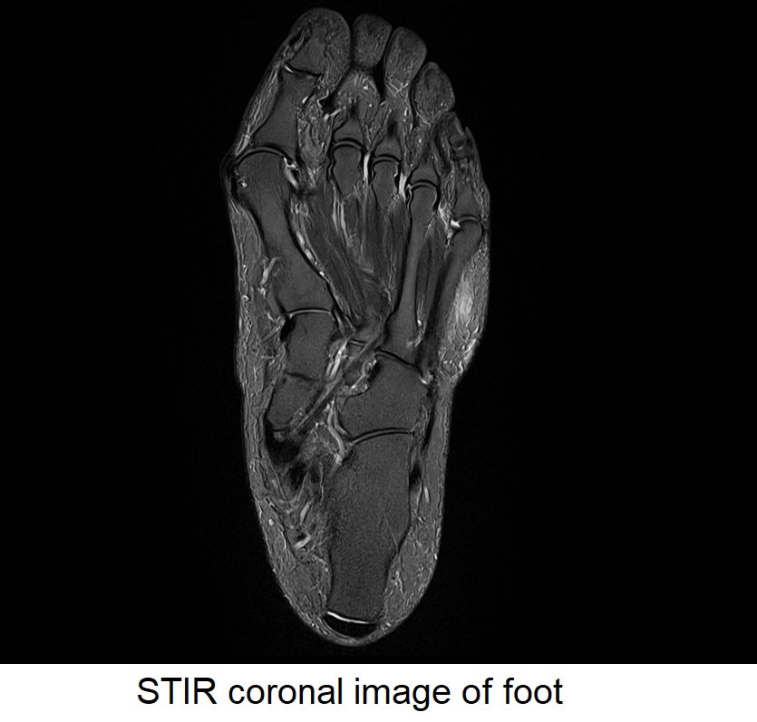 STIR coronal image of foot