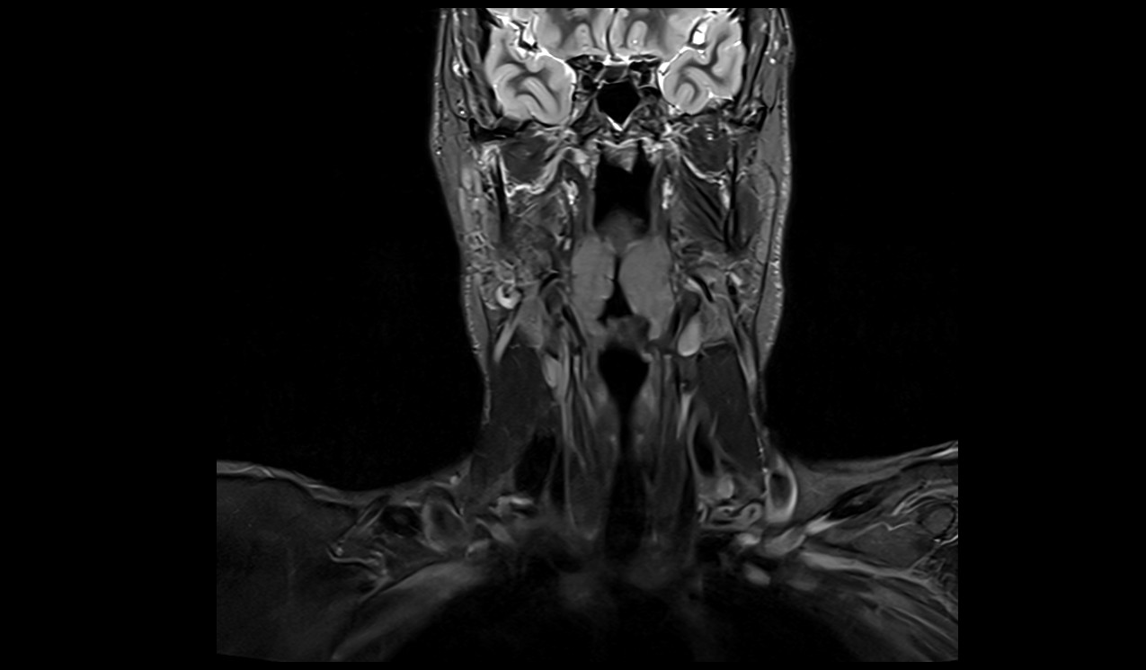 STIR coronal image of neck