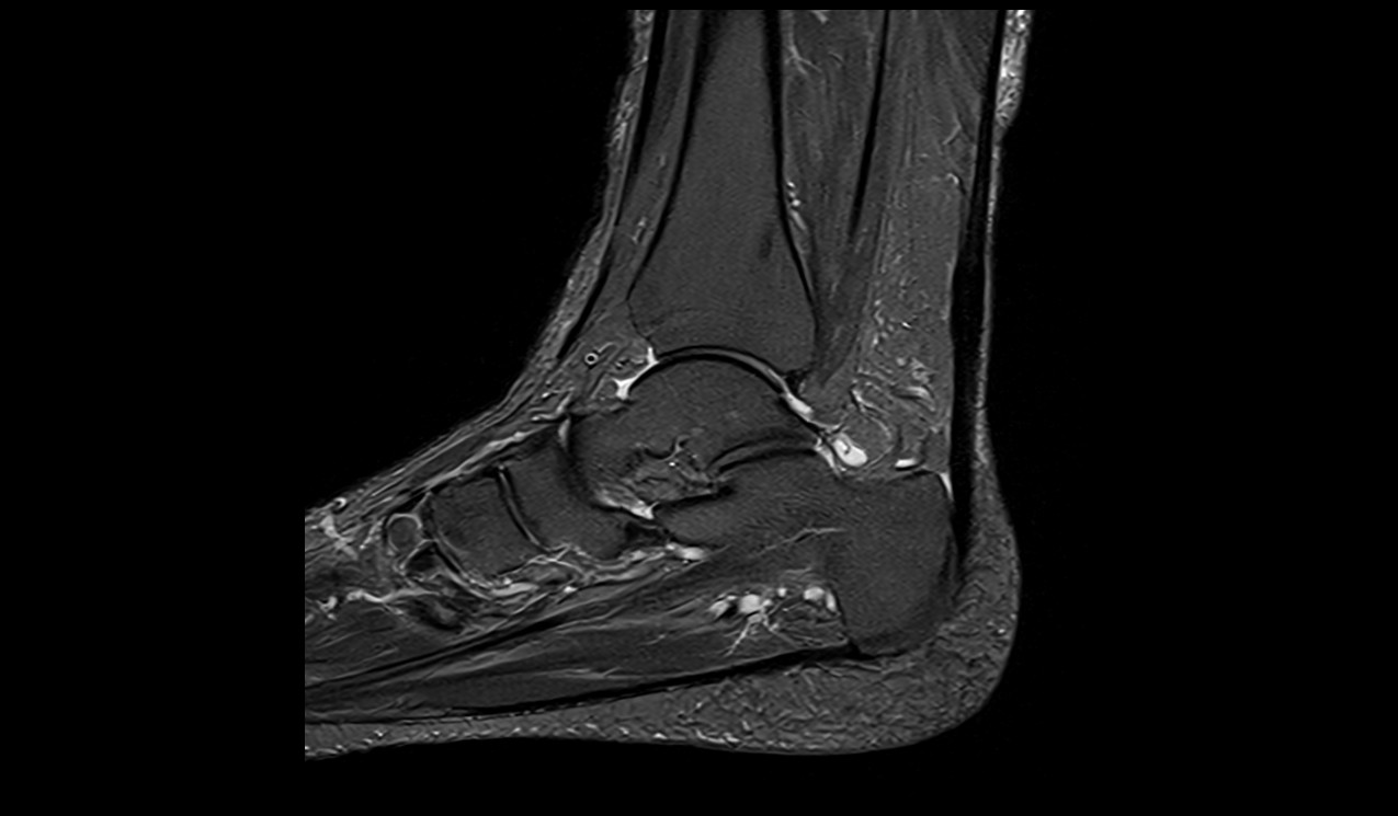 STIR sagittal image of ankle