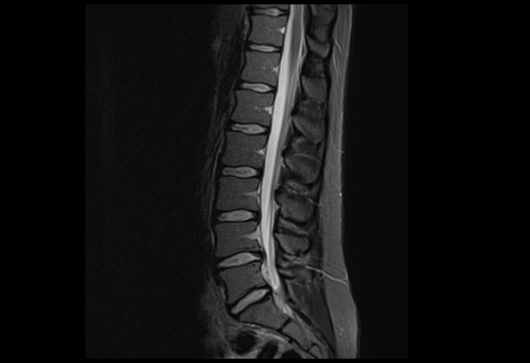 STIR sagittal image of lumbar spine