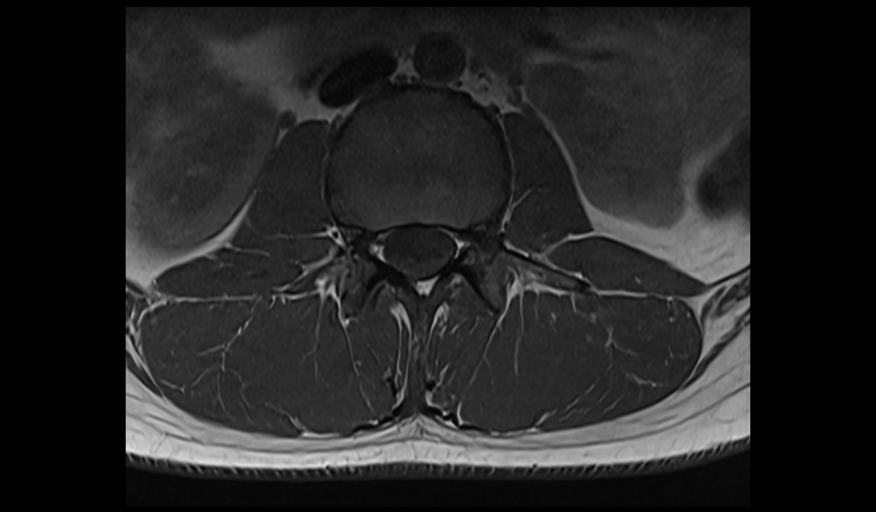 T1-weighted turbo spin-echo axial image of the lumbar spine