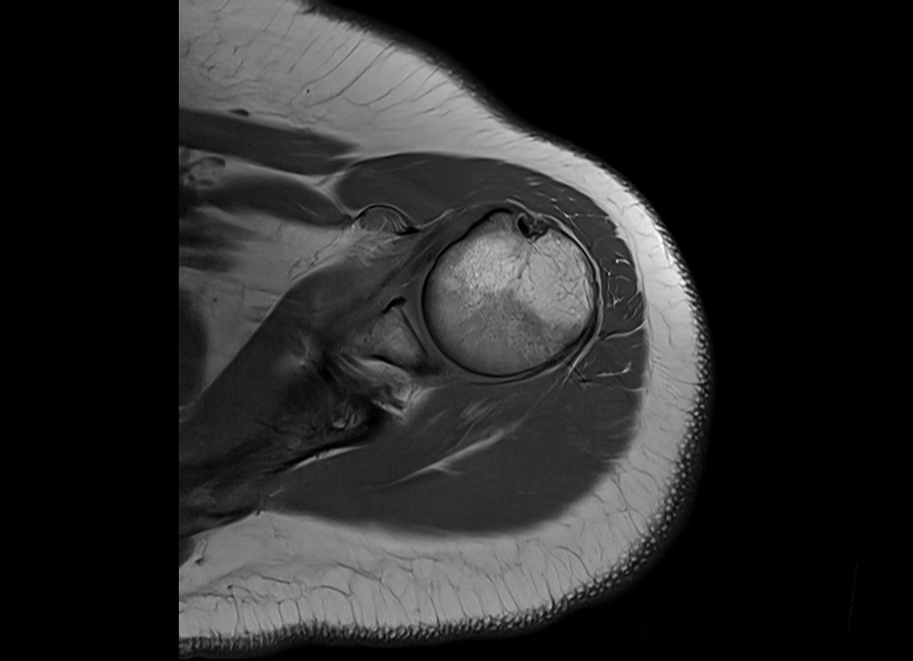 MRI T1-weighted turbo spin-echo axial image of the shoulder