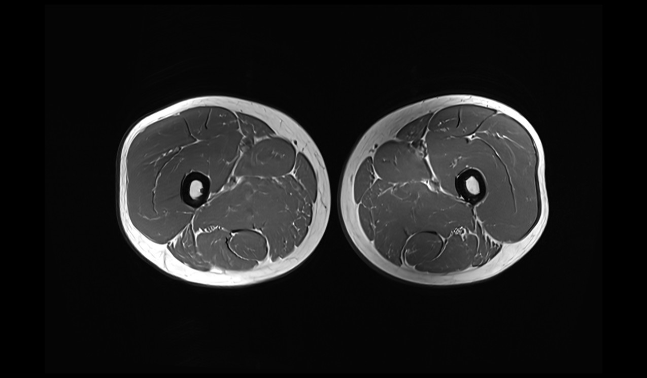 T1-weighted turbo spin-echo axial image of the thigh