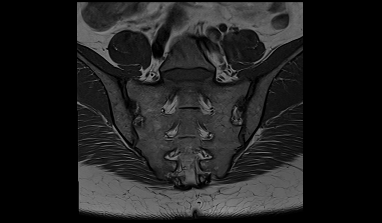 MRI T1-weighted turbo spin-echo coronal image of the SIJ