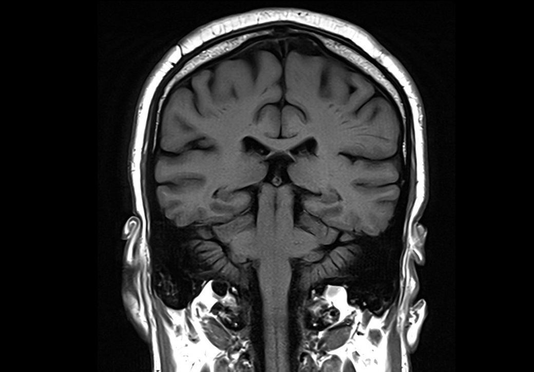 T1-weighted turbo spin-echo coronal image of the brain
