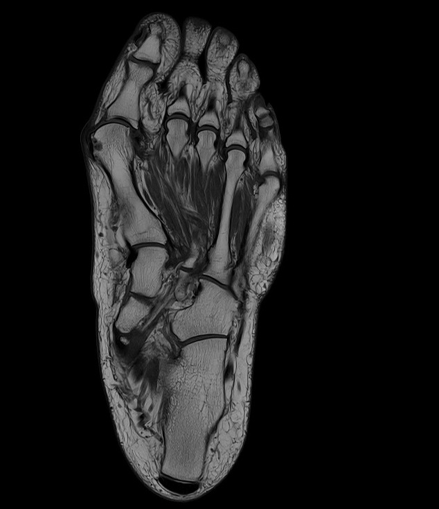 T1-weighted turbo spin-echo coronal image of the foot